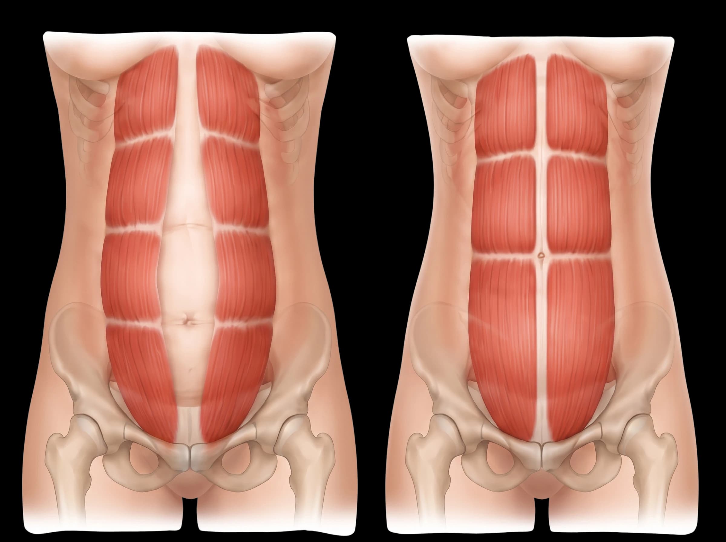 Medical illustration comparing a belly with a mommy pouch to normal abdominal muscles